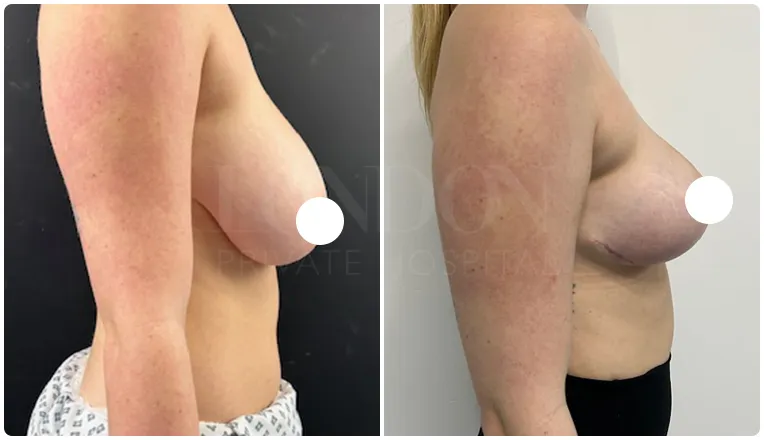 breast reduction surgery before and after patient - 7-v2