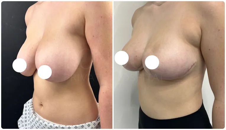 breast reduction surgery before and after patient - 7-v3