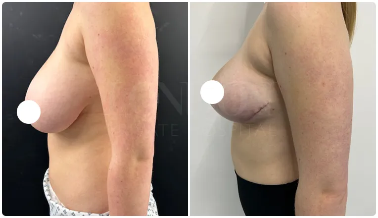 breast reduction surgery before and after patient - 7-v4