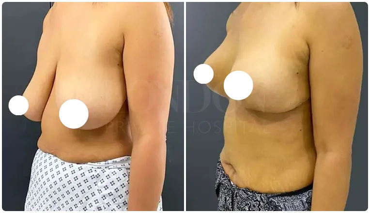 breast uplift before and after patient - 5-v1