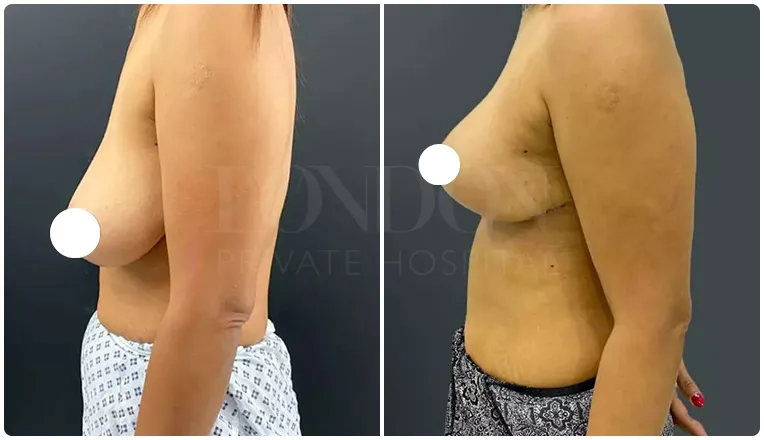 breast uplift before and after patient - 5-v2