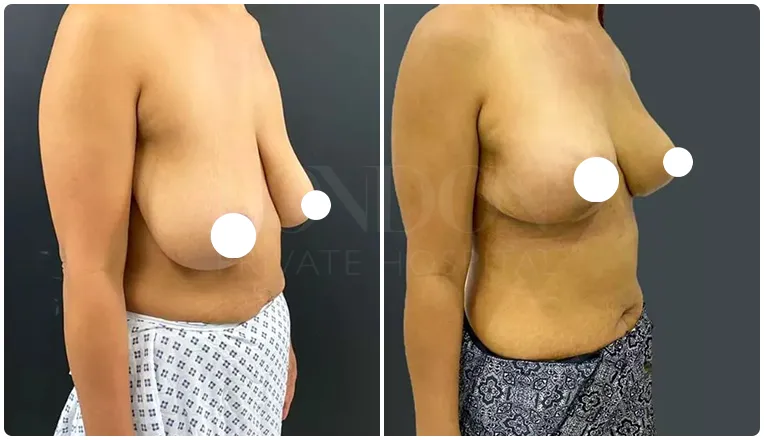 breast uplift before and after patient - 5-v3