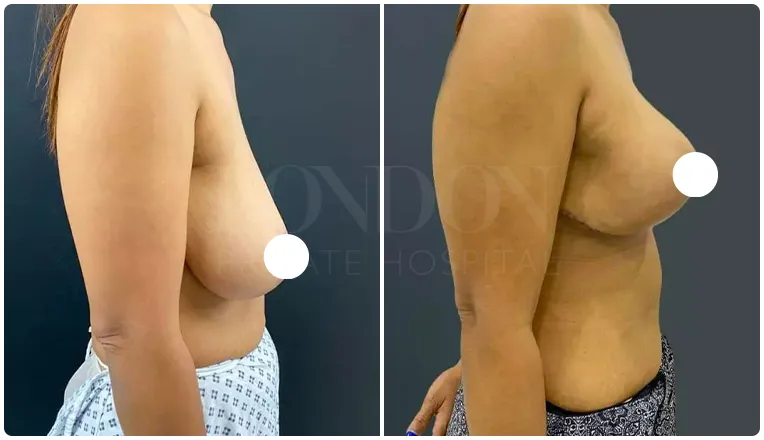 breast uplift before and after patient - 5-v4