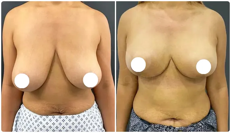 breast uplift before and after patient - 5