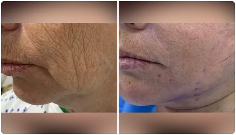 facelift before and after patient -1- v1