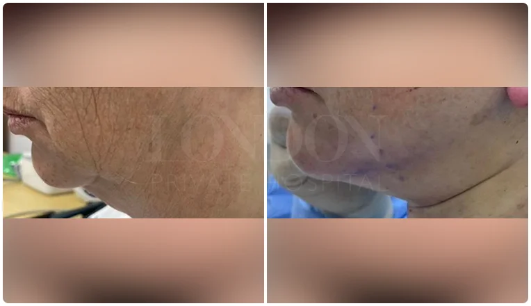 facelift before and after patient -1- v2