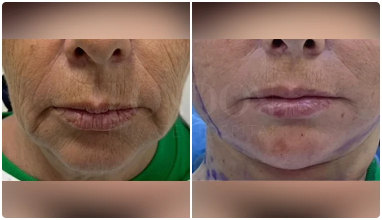 facelift before and after patient -1