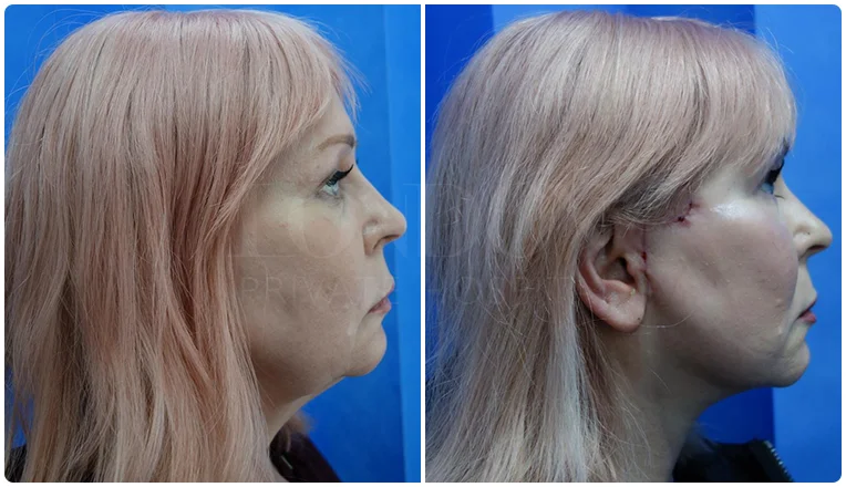 facelift before and after patient -2- v1