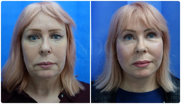 facelift before and after patient - 2