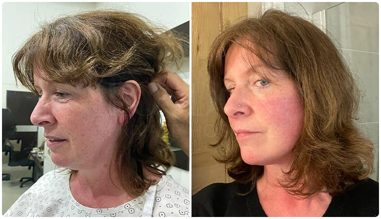 facelift before and after patient -3- v1