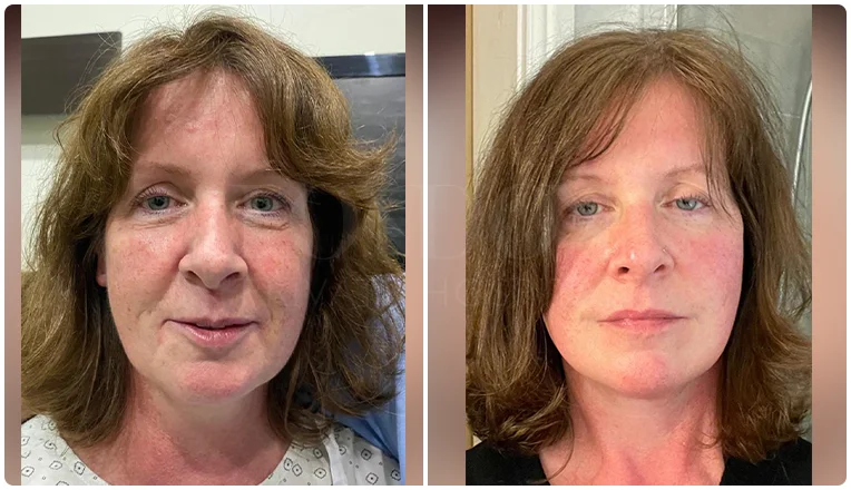 facelift before and after patient - 3