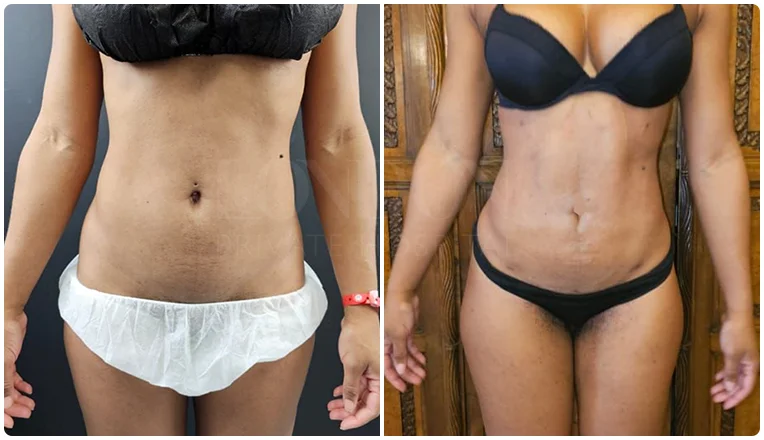 lipo before and after stomach patient-1