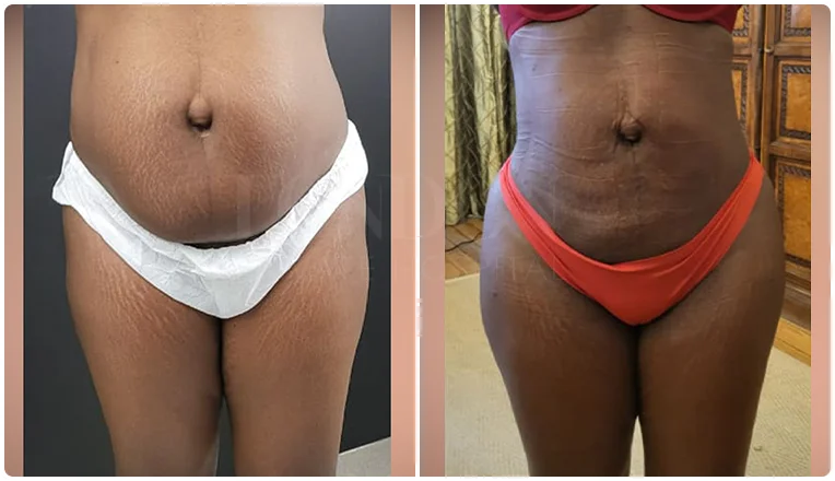 lipo before and after stomach patient-2