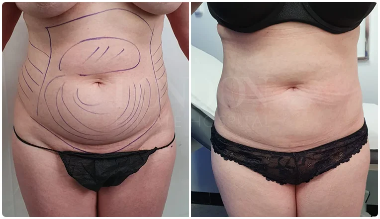 lipo before and after stomach patient-3