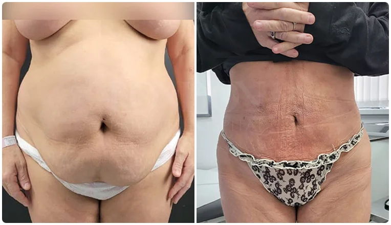 lipo before and after stomach patient