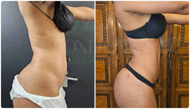 lipo female abs before and after patient-1