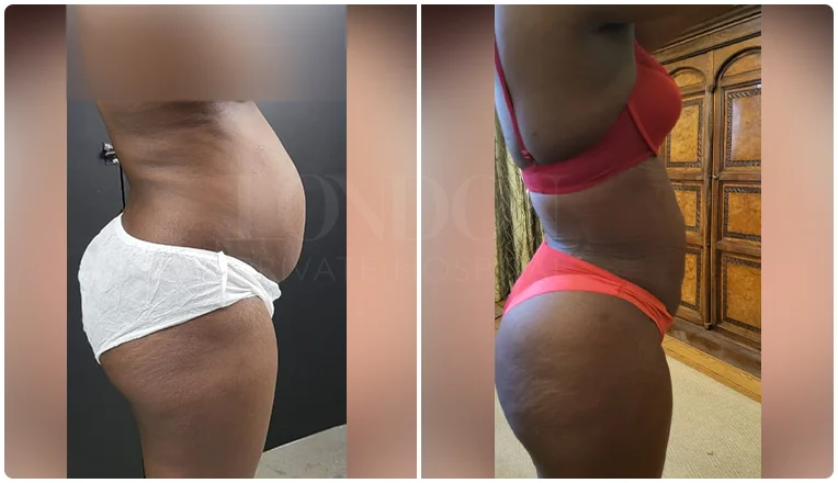 lipo female abs before and after patient-2