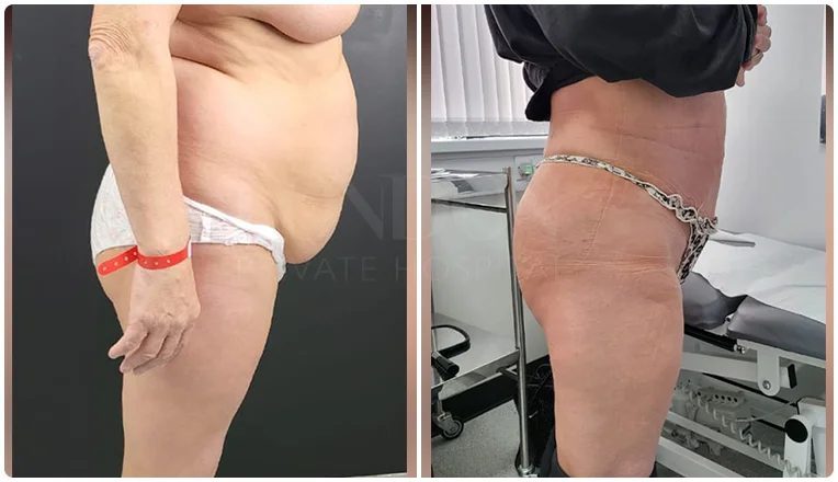 lipo female abs before and after patient