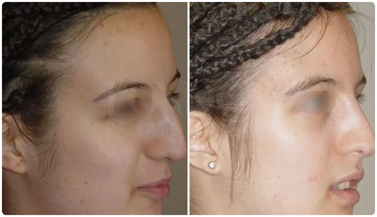 nosejob before and after patient - 6