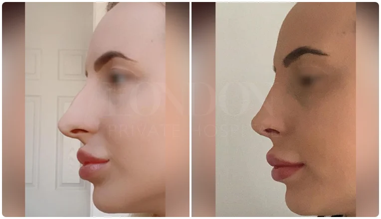 nosejob before and after patient - 7