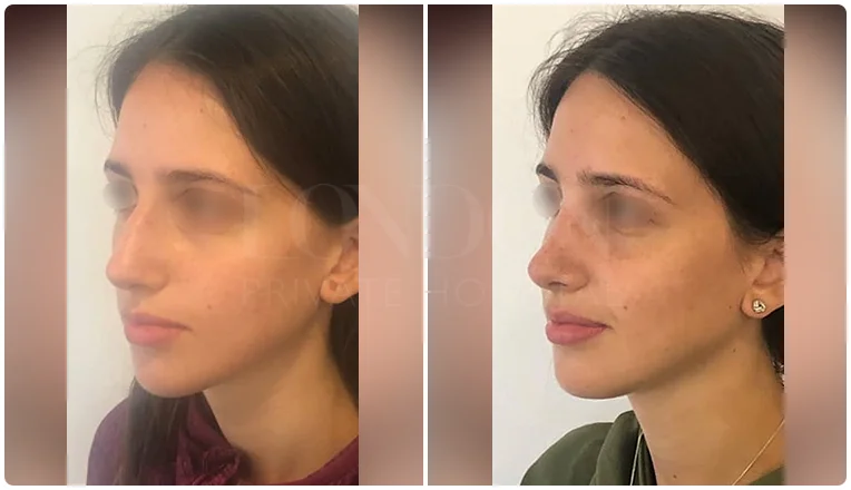 nosejob before and after patient - 8