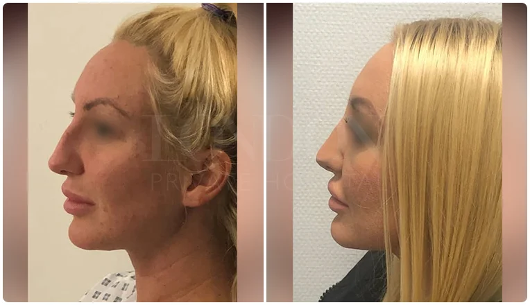 nosejob before and after patient - 9