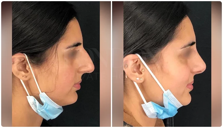 rhinoplasty before and after patient - 1-v1