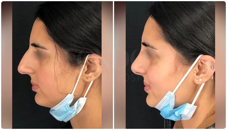 rhinoplasty before and after patient - 1