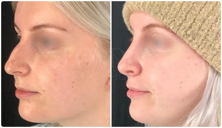 rhinoplasty before and after patient-2