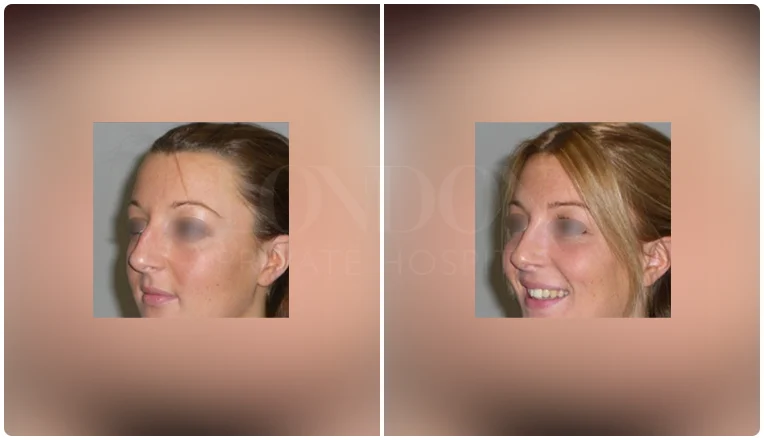 rhinoplasty before and after patient - 3