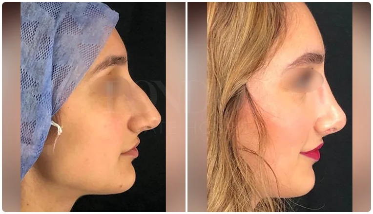 rhinoplasty before and after patient - 4-v1