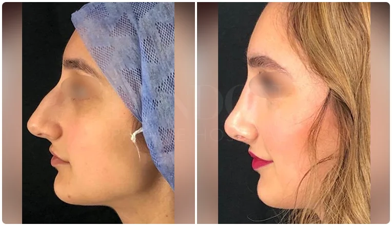 rhinoplasty before and after patient - 4