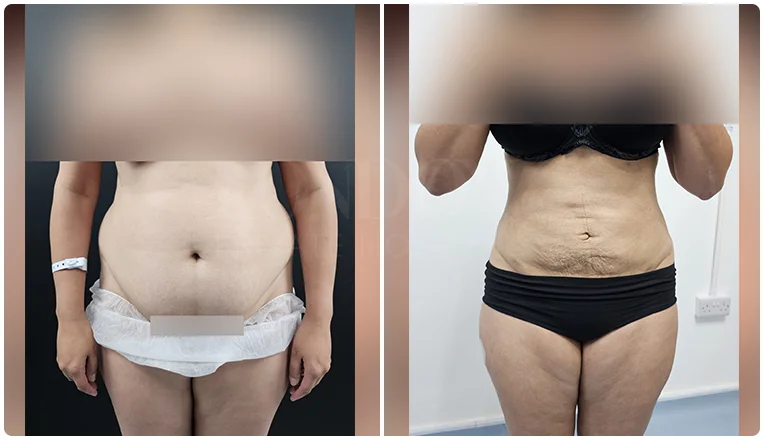 vaser lipo before and after stomach patient-1