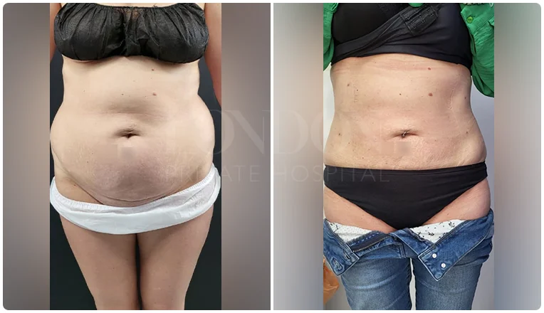 vaser lipo before and after stomach patient-3