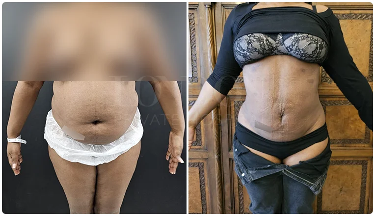 vaser lipo before and after stomach patient-5