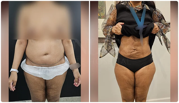 vaser lipo before and after stomach patient-6