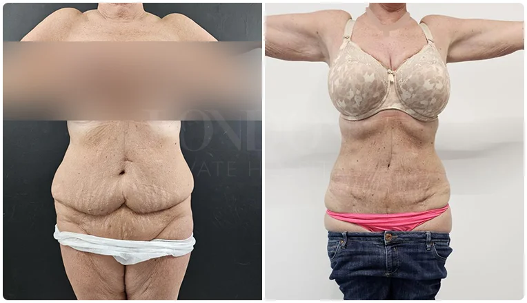 vaser lipo before and after stomach patient