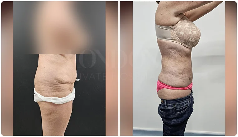 vaser lipo female abs before and after patient-1-v1