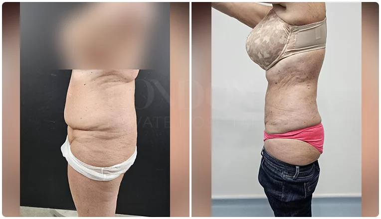 vaser lipo female abs before and after patient-1