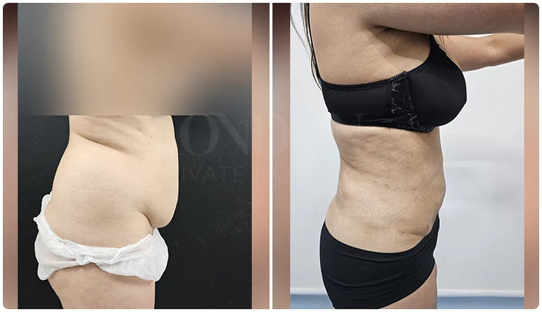 vaser lipo female abs before and after patient-2-v1