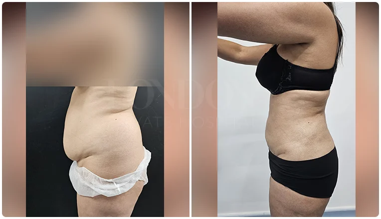 vaser lipo female abs before and after patient-2