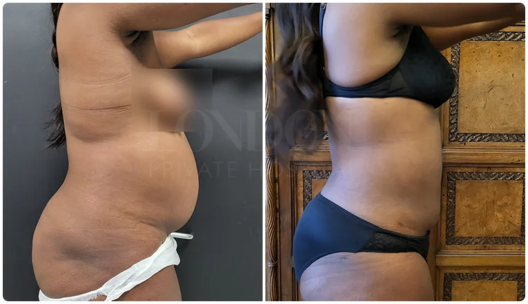 vaser lipo female abs before and after patient-3-v1