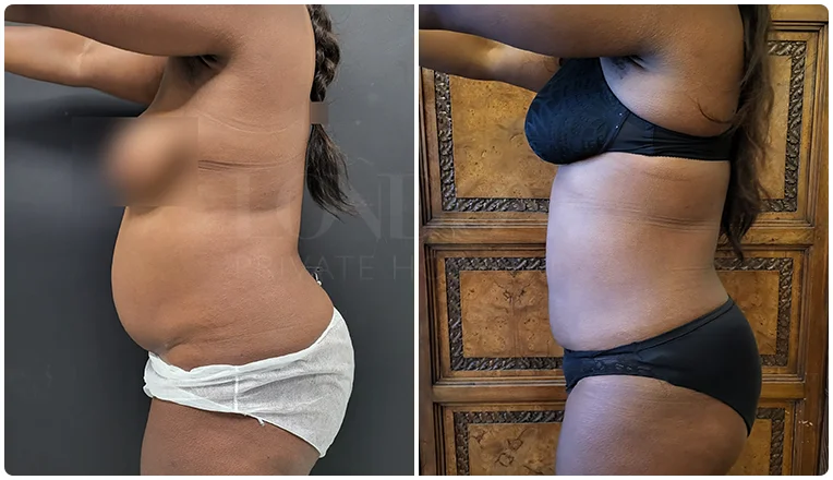 vaser lipo female abs before and after patient-3