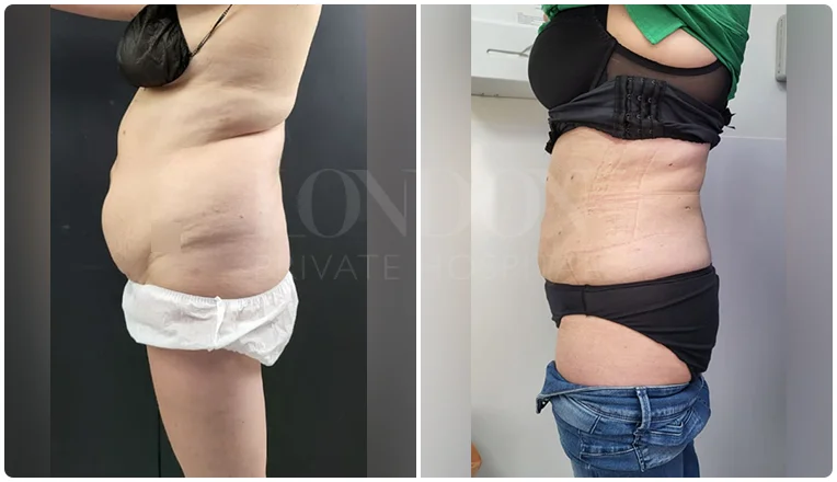 vaser lipo female abs before and after patient-4