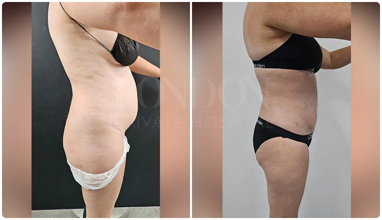 vaser lipo female abs before and after patient-5-v1