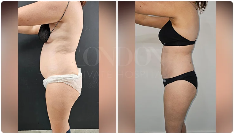 vaser lipo female abs before and after patient-5