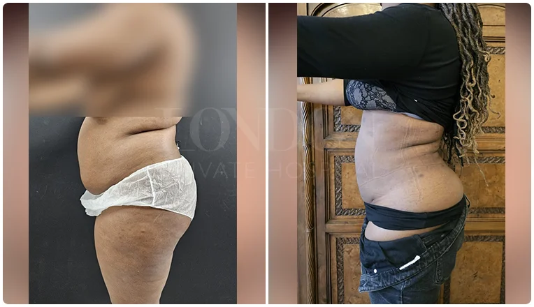 vaser lipo female abs before and after patient-6-v1