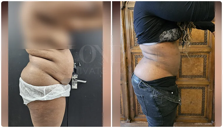 vaser lipo female abs before and after patient-6