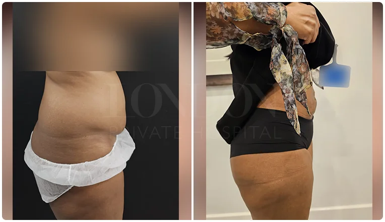 vaser lipo female abs before and after patient-7-v1