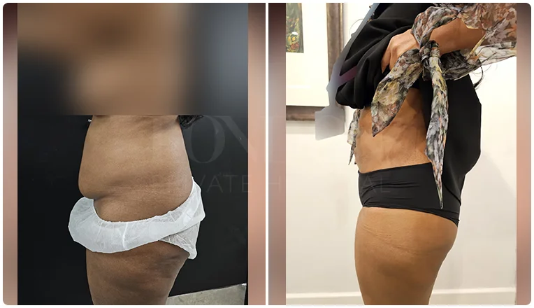 vaser lipo female abs before and after patient-7